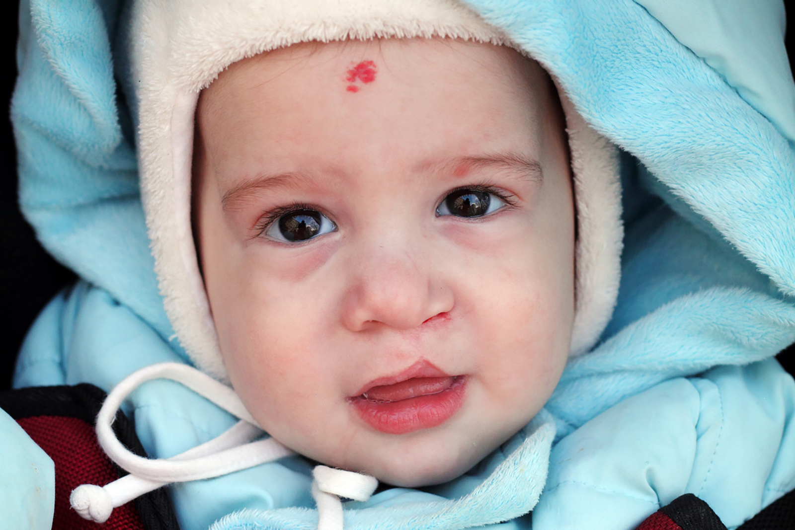 Baby with Cleft lip